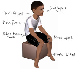 low-muscle-tone-posture